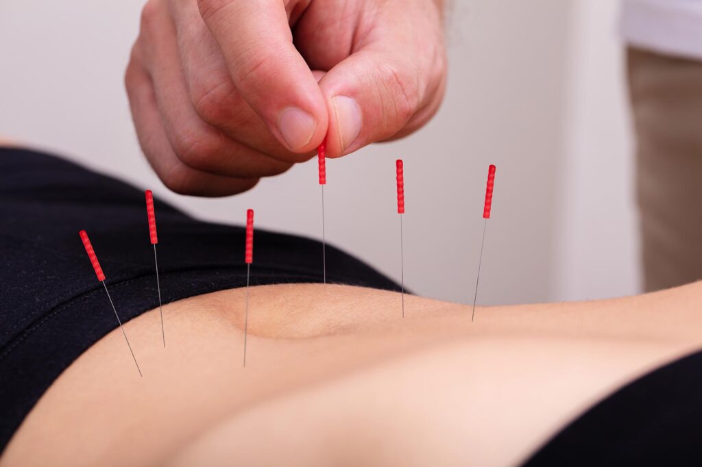 The Truth About Acupuncture